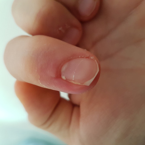 Finger  - (Operation, Entzündung, Nägel)