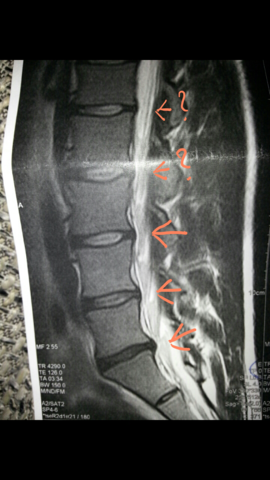 Bandscheibenprotrusion Bandscheibenprotrusion