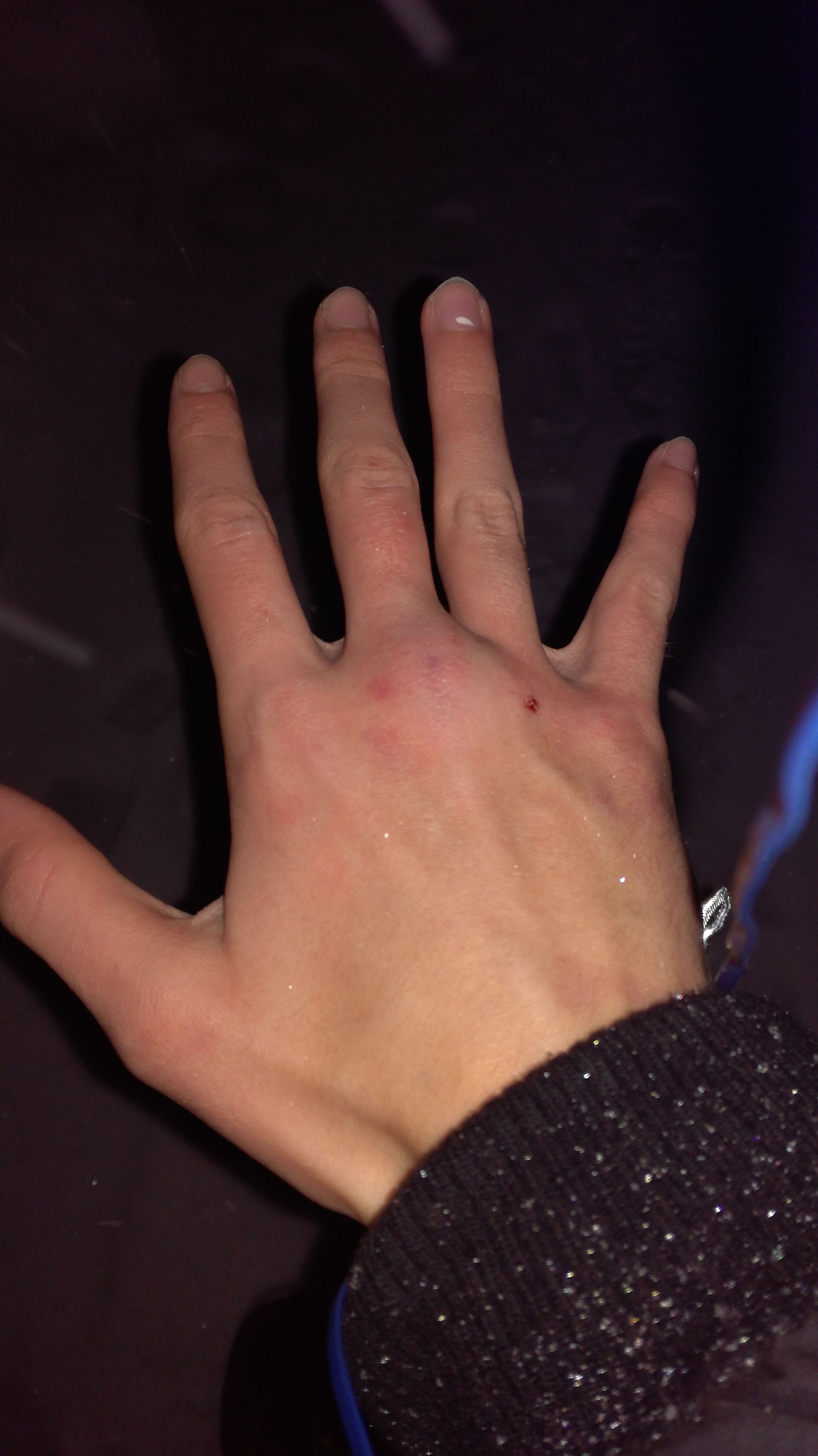 Heilungsdauer Gebrochener Finger Fingerbruch