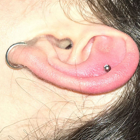 Angeschwollener Helix  - (Gesundheit und Medizin, Piercing, Ohr)