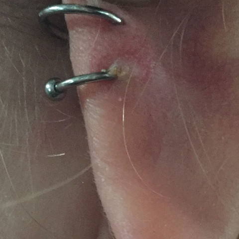 Rückseite des Loches nach 4 1/2 Wochen  - (Piercing, Entzündung, Helix)