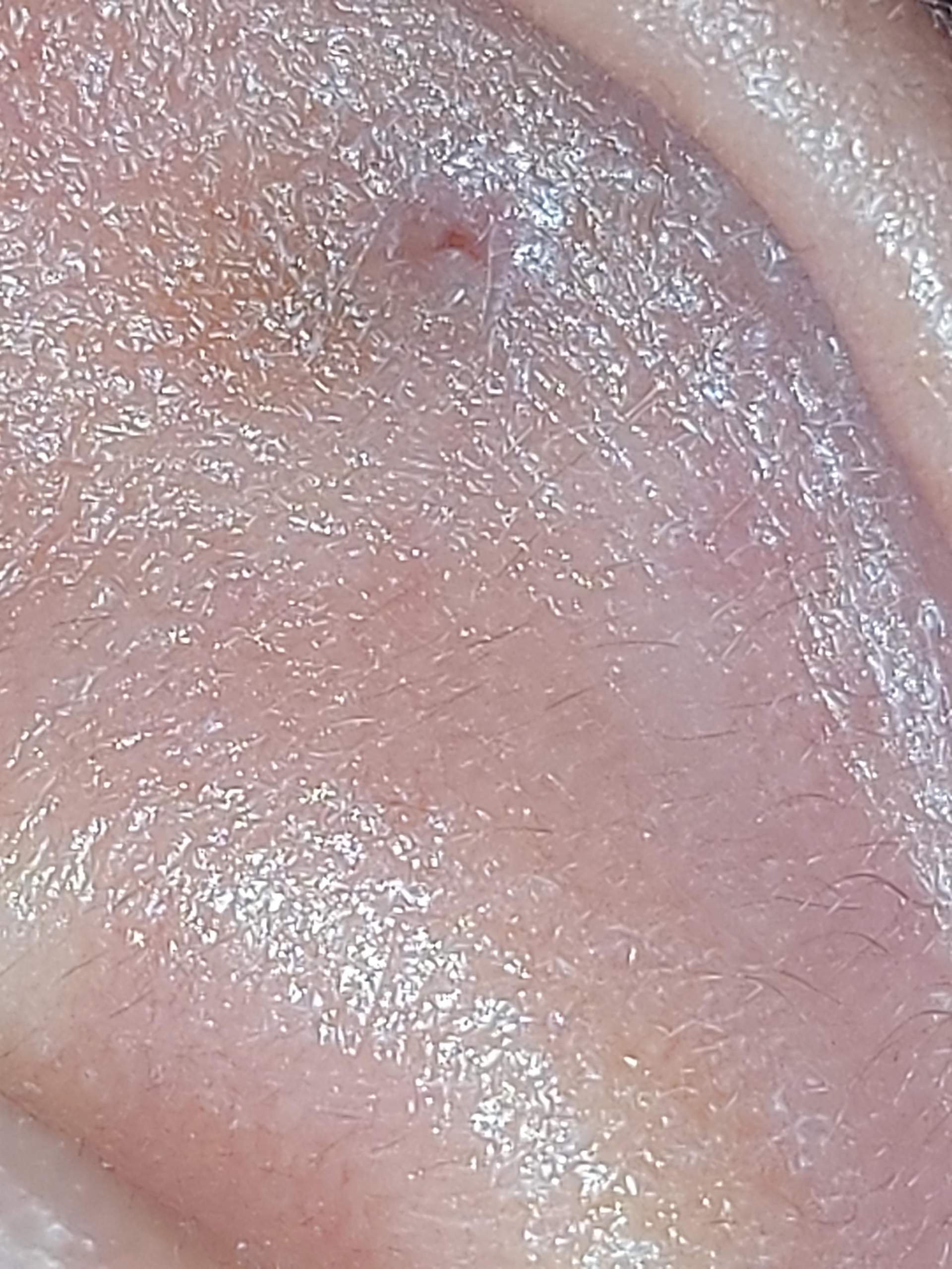 Helix Tut Weh Aber Nicht Entzündet Helix tut seit 2,5 Jahren weh...? (Gesundheit und Medizin, Piercingschmuck)