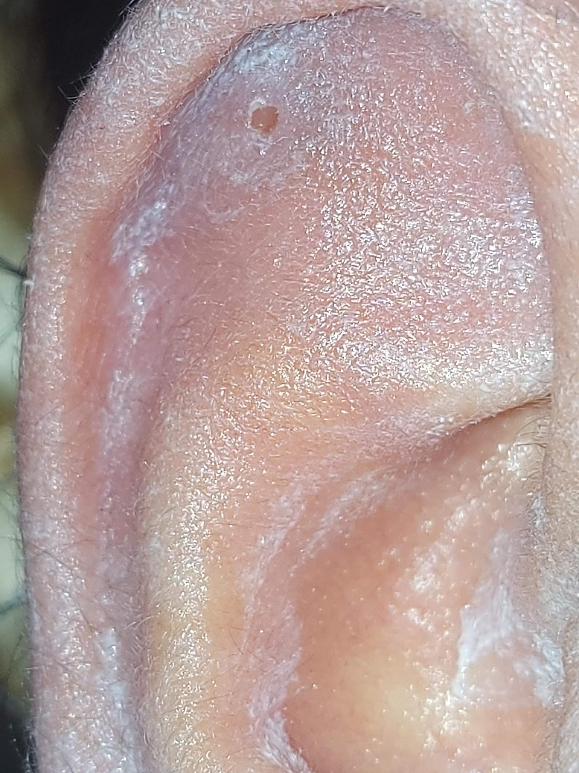 Helix Tut Weh Aber Nicht Entzündet Helix tut seit 2,5 Jahren weh...? (Gesundheit und Medizin, Piercingschmuck)