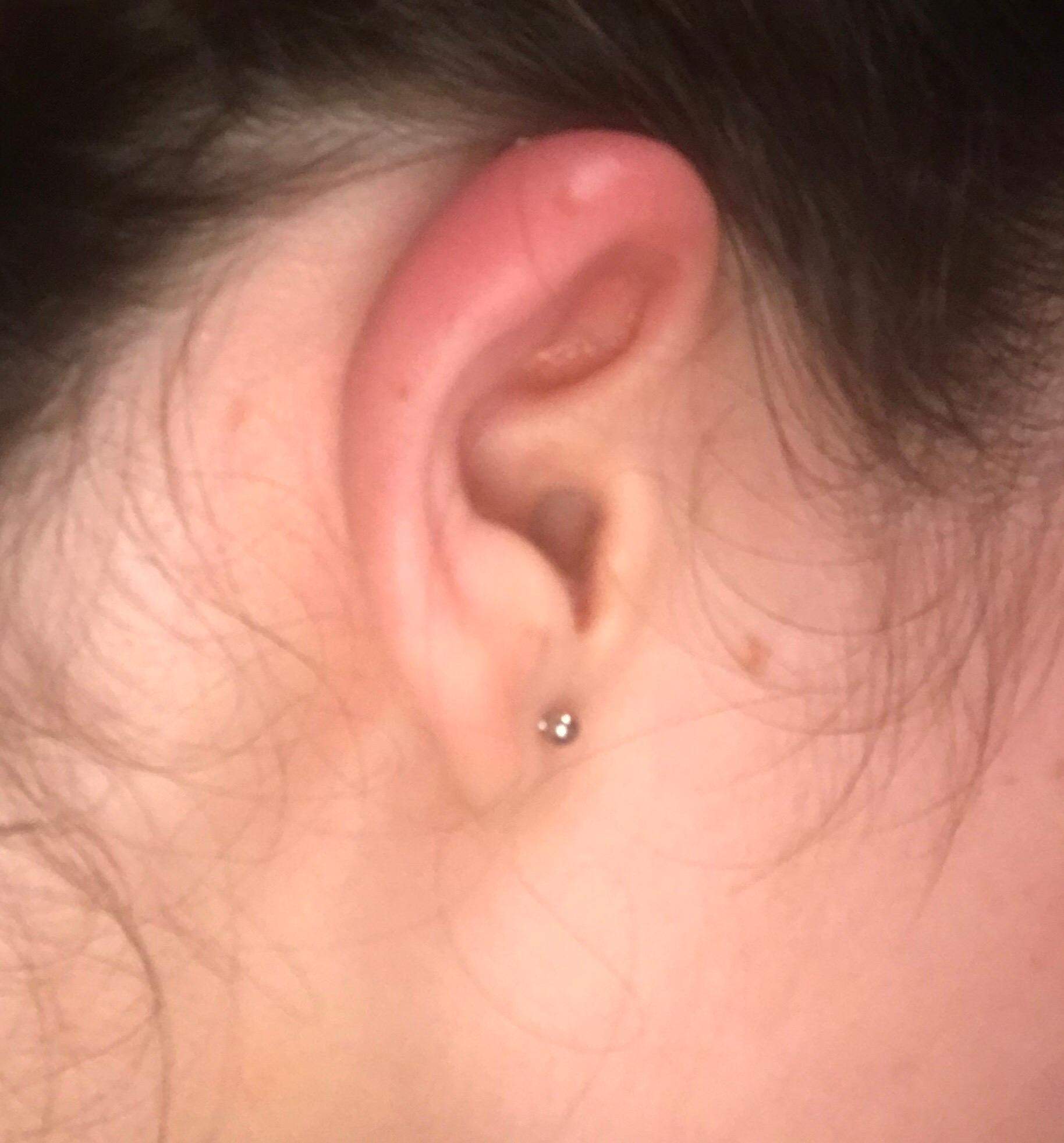 Helix Tut Weh Aber Nicht Entzündet Helix tut weh, ist gerötet und pocht? (Gesundheit und Medizin