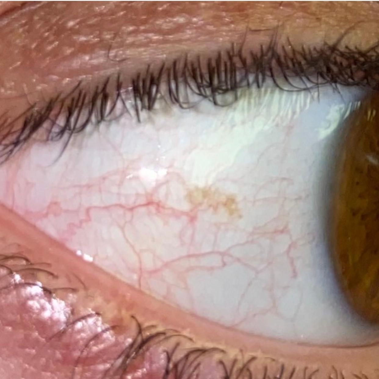 Hell brauner Fleck im Augen? (Augenarzt)