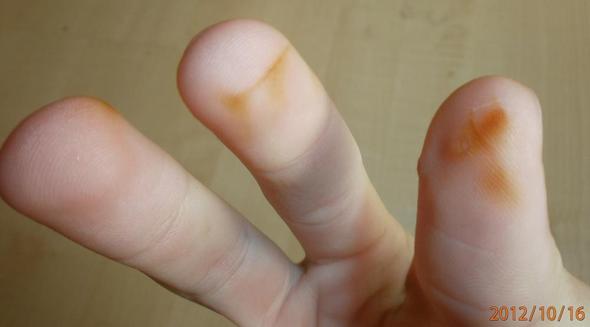 Hellbraune Flecken an den Fingern 