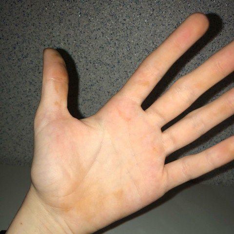 Hier ein Bild meiner Hand  - (Haut, Flecken, Hautflecken)