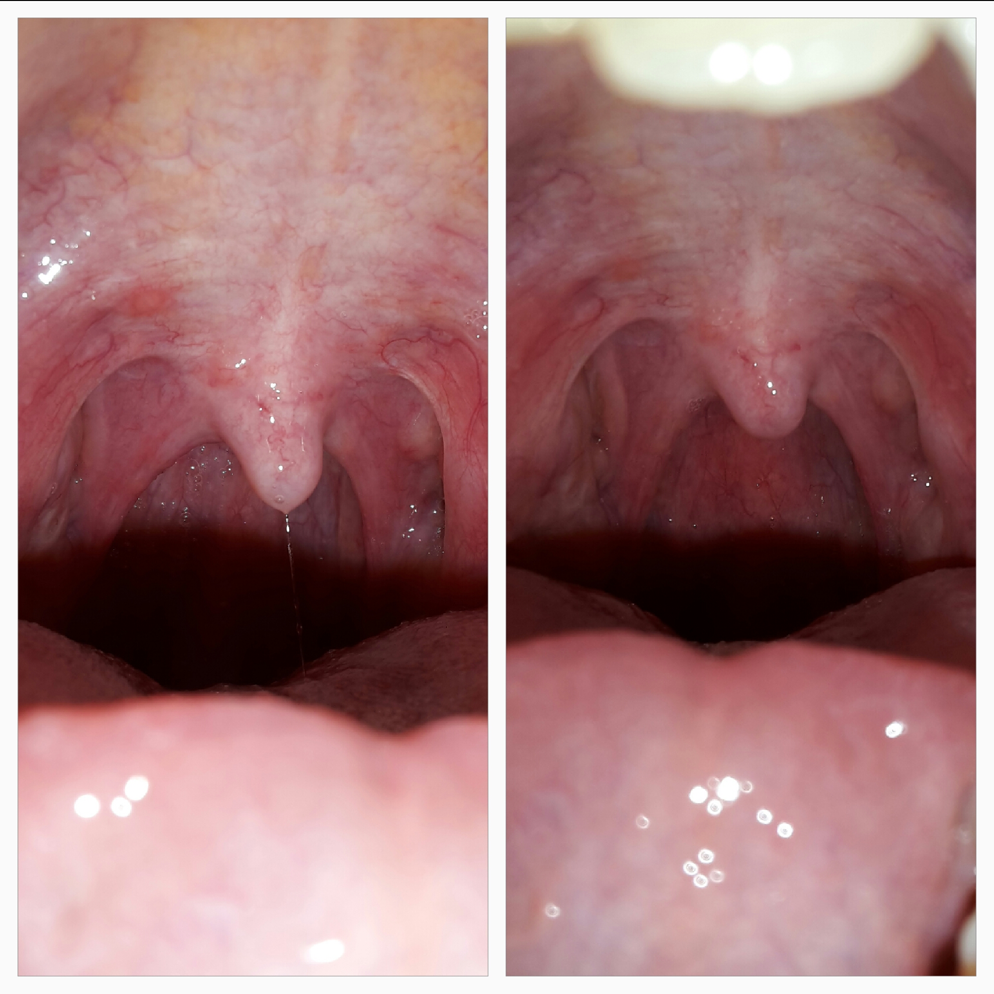 35++ Weisse flecken im rachen bilder , Helle Flecken im Hals / Rachen ? (Gesundheit, Krankheit, Mund)