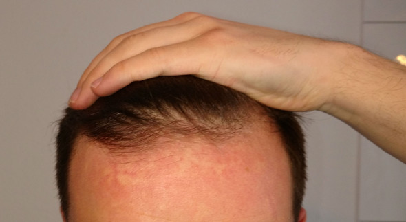 Helle Flecken Reizung Oder Ausschlag Am Haaransatz Haare Haut Hautpflege