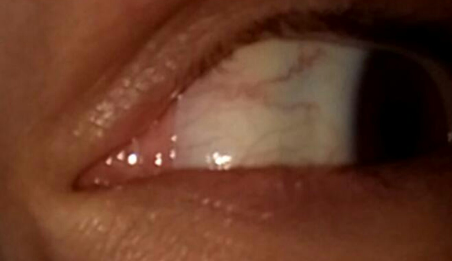 hellgrauer Fleck auf der Lederhaut (Auge) (Arzt, Schmerzen, Augen)