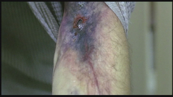 Heroinarm - (Drogen, Heroin)