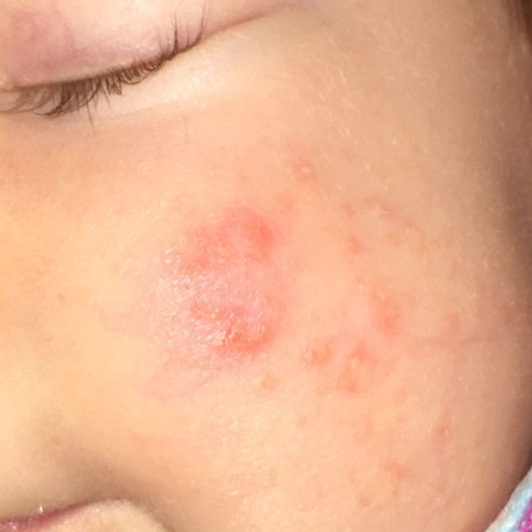 Herpes Akne Oder Pickel Beim Baby Was Ist Das Haut Dermatologie Rotung