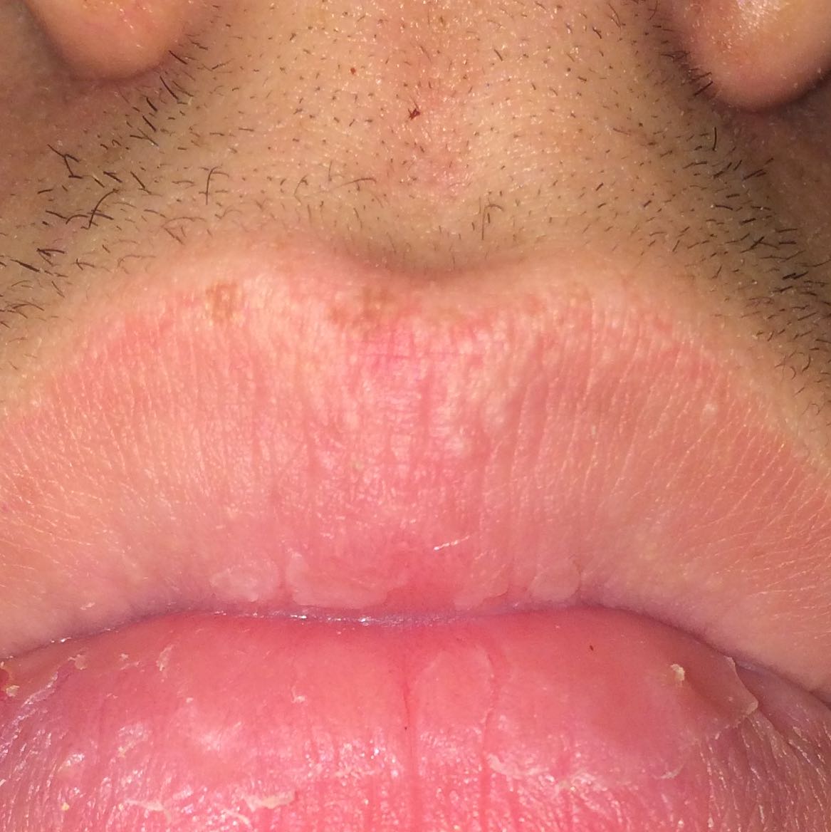Herpes auf dem Bild? (Arzt, Creme, Lippe)