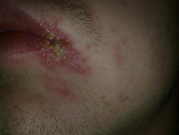 Herpes Brandblasen Oder Pilzinfektion Lippe Pilze Blase Herpes Brandblasen Oder Pilzinfektion Lippe Pilze Blase