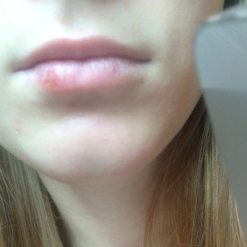 Herpes Endstadium küssen erlaubt? (grind)