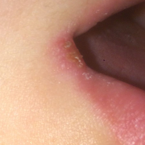 Im Mundwinkel sind kleine Bläschen zu erkennen  - (Schmerzen, Infektion, Herpes)