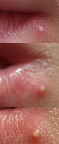 Bild vom Pickel an bzw leicht unter der Lippe - (Gesundheit, Pickel, Herpes)