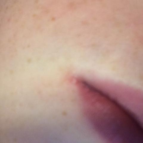 Habe Ich Herpes Oder Etwas Anderes Pickel Mundwinkel