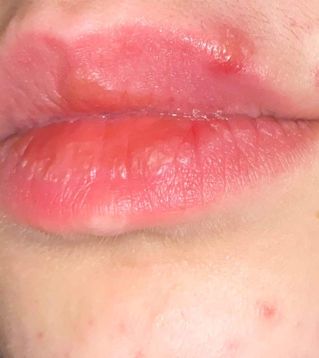 Herpes oder Pickel? (Gesundheit und Medizin, Lippe, Lippenherpes)