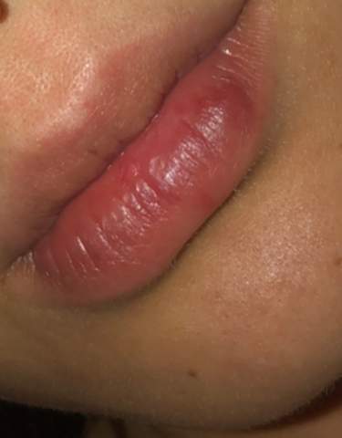 Lippe taub und geschwollen