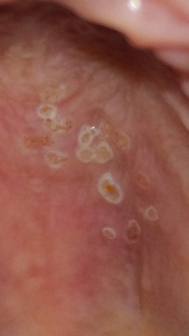 Wann geht herpes im mund weg