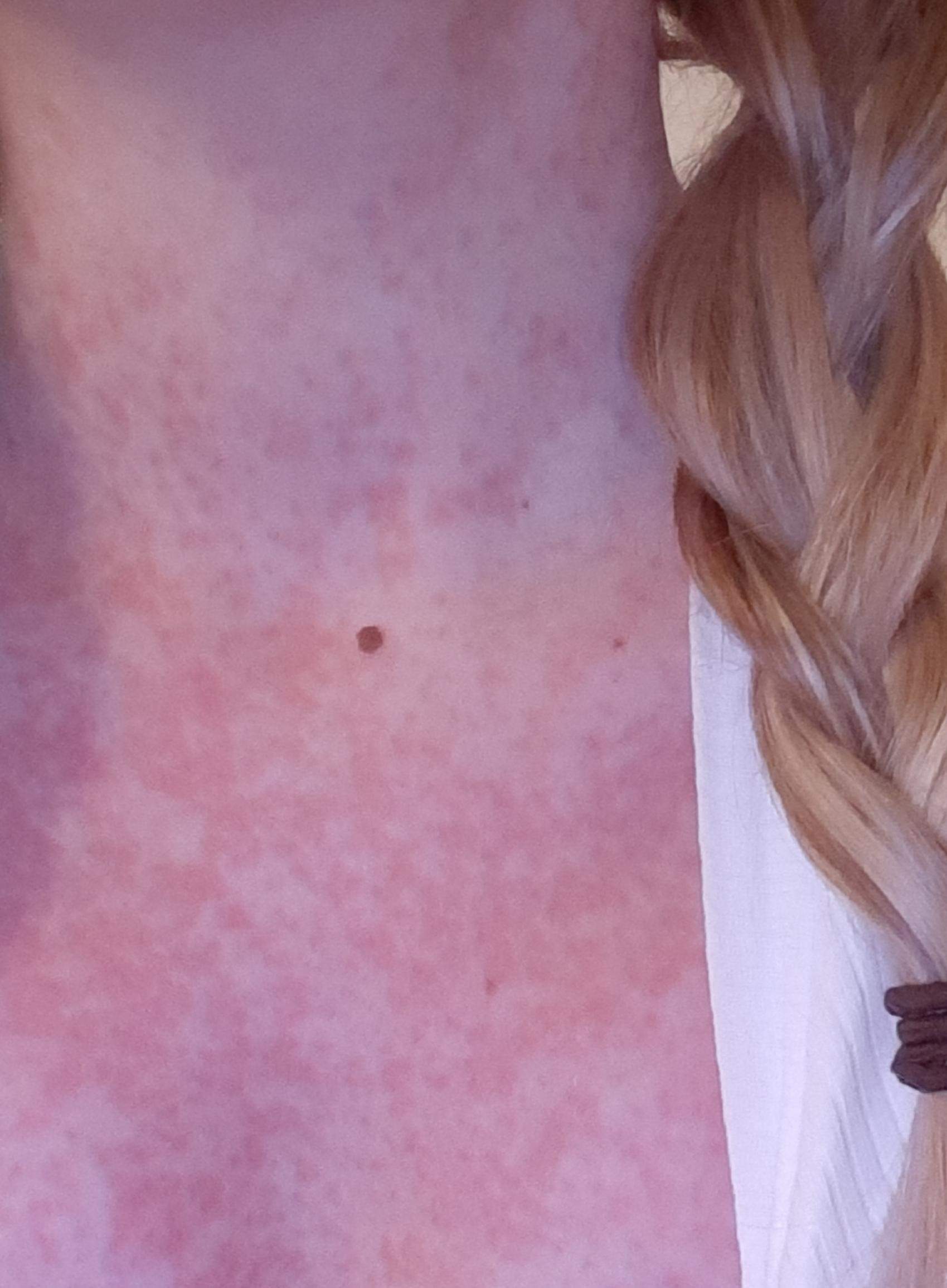 Hey habe den Epsteinbarr virus ( pfeifferisches Drüsenfieber) und jetzt