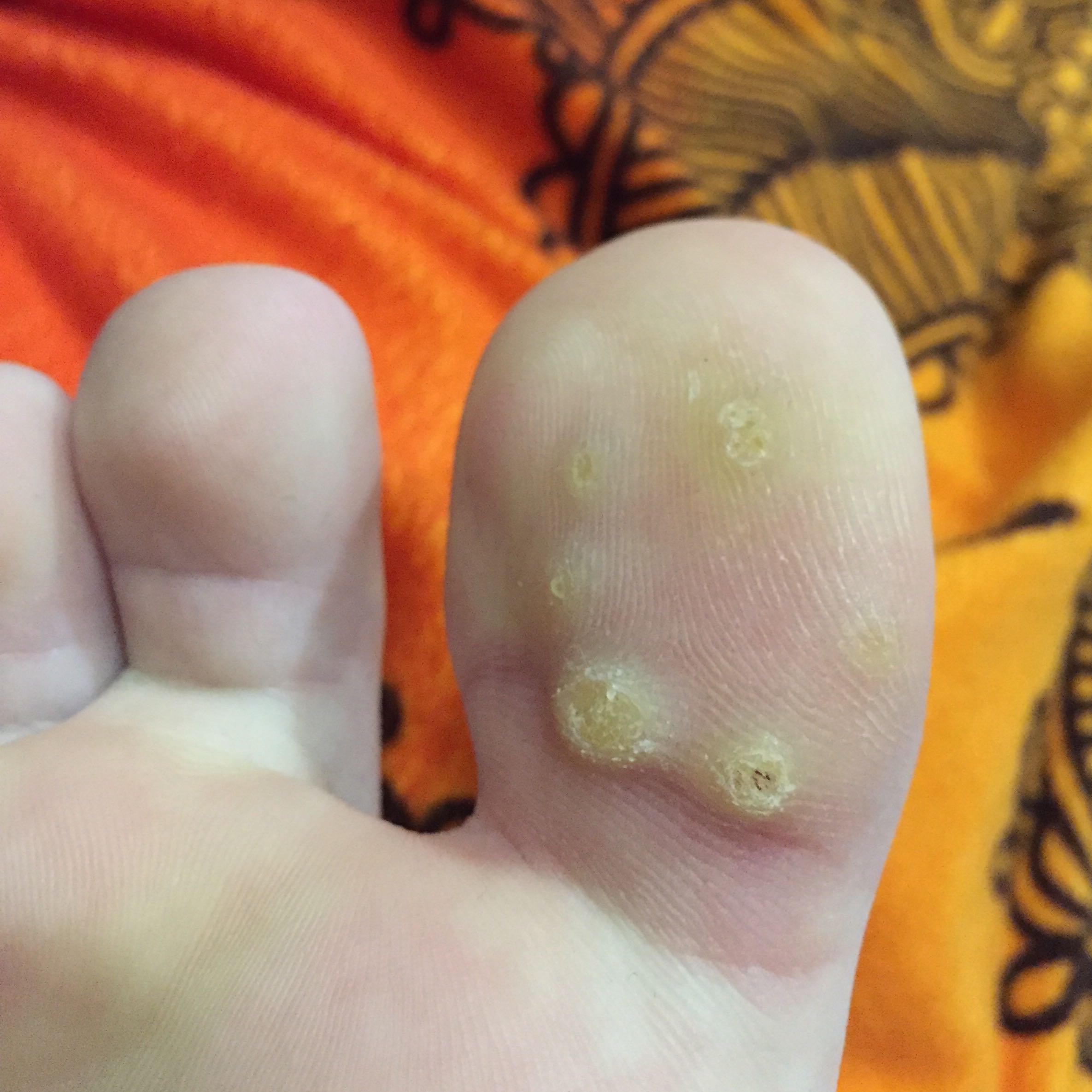 hey ich hab so komische unterm grossen zeh ich weis nicht genau was das ist warzen