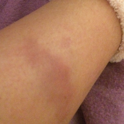 Kleine Blaue Flecken Am Bein Ursachen Fur Braune Flecken An Den Beinen 2020 01 10 Kleine Blaue Flecken Am Bein Ursachen Fur Braune Flecken An Den Beinen 2020 01 10