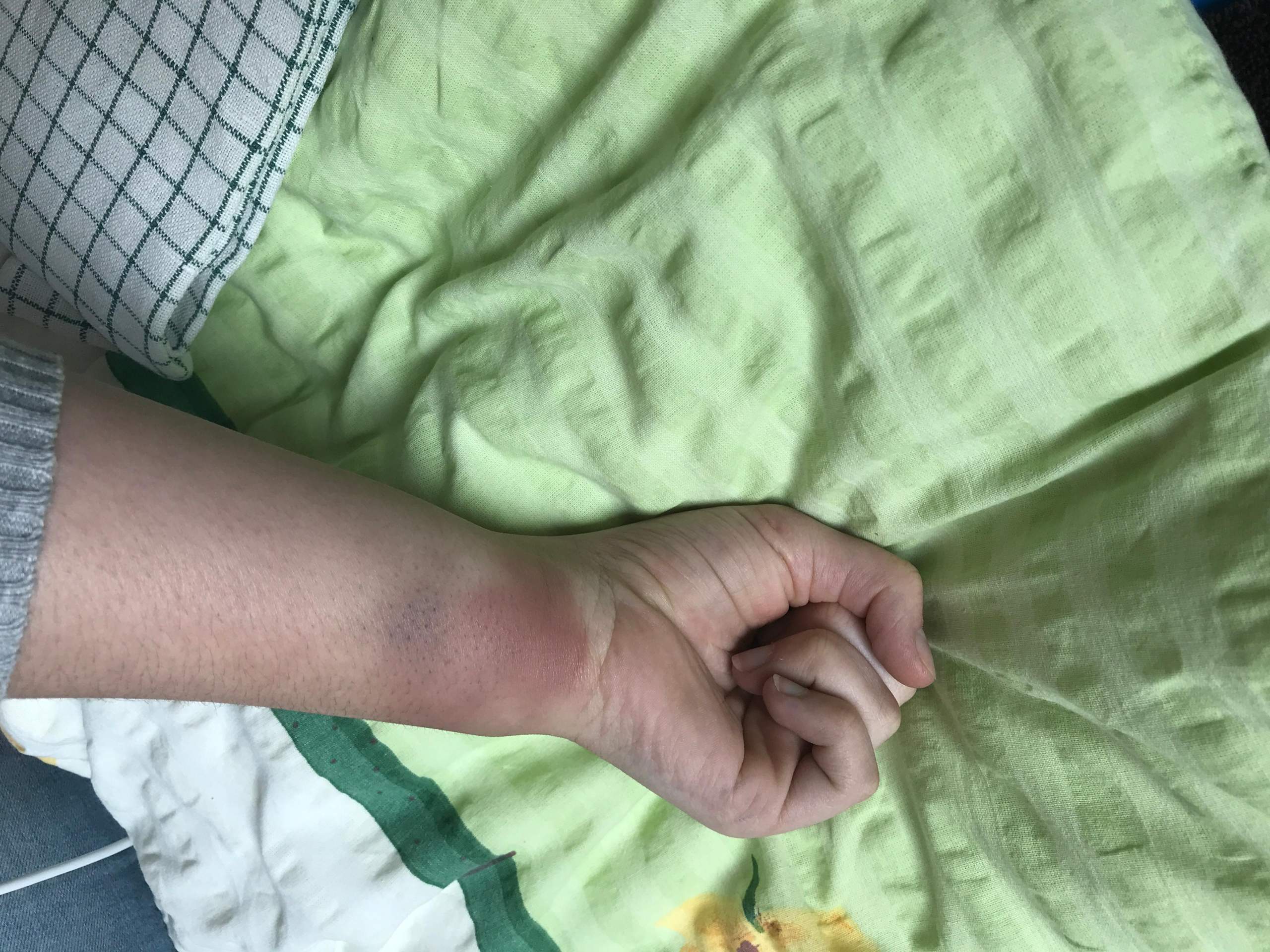 Hey, ist das gebrochen? Oder nur geprellt? (Gesundheit, Medizin, Bruch)