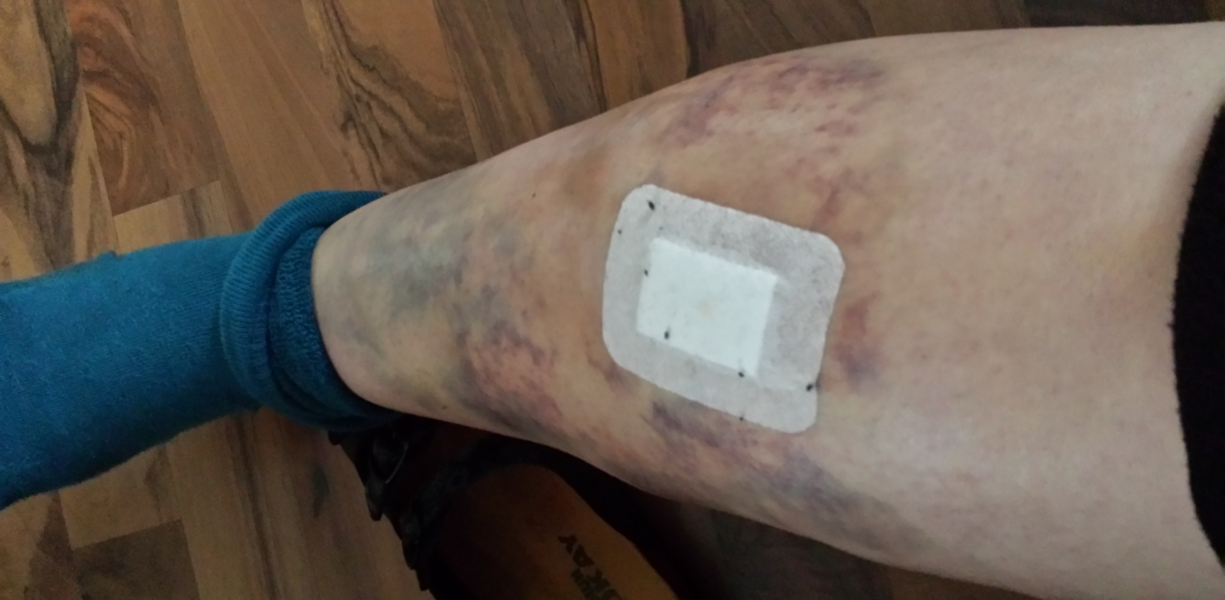 hey leute, hat sich jemand schon ein hämatom ausräumen lassen? wie läuft das ab? bluterguss räumen hey leute, hat sich jemand schon ein hämatom ausräumen lassen? wie läuft das ab? bluterguss räumen