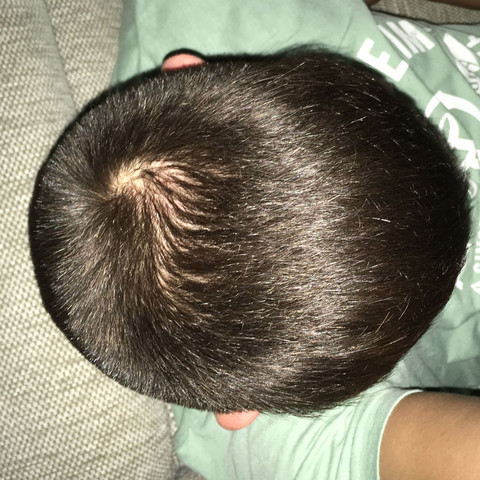 Hey Wirbel Oder Glatze Haare