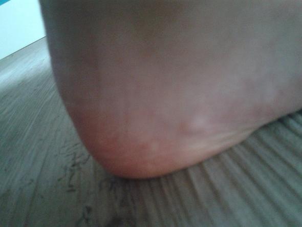Mein Fuß: - (Füße, Ödem, Knötchen)