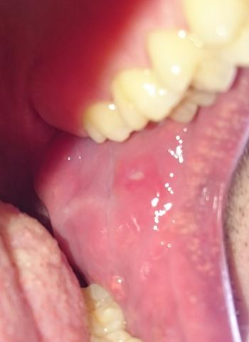 Ist Das Auf Dem Bild Herpes Oder Ne Aphte Gesundheit Mund Ist Das Auf Dem Bild Herpes Oder Ne Aphte Gesundheit Mund
