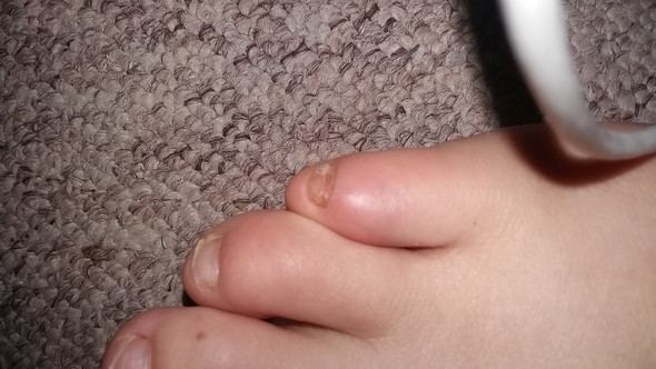 Hhangen Geblieben Und Der Kleine Zeh Gebrochen Hhangen Geblieben Und Der Kleine Zeh Gebrochen