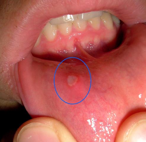Mundfäule - (Verletzung, Mund)