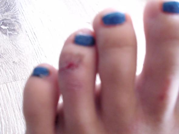 Tape gebrochen kleiner zeh Gebrochener Zeh