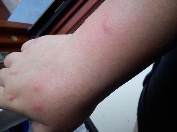 An meiner Hand bzw. Arm - (Krankheit, Insekten, Allergie)