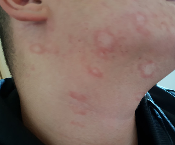 Hilfe Hautauschlag Hautpilz Im Gesicht Wer Kennt Das Ausschlag Hilfe Hautauschlag Hautpilz Im Gesicht Wer Kennt Das Ausschlag