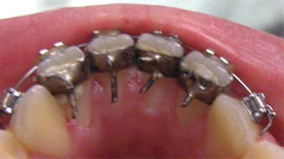 Zahnspikes - (Zahnspange, Kieferorthopäde, Zunge)