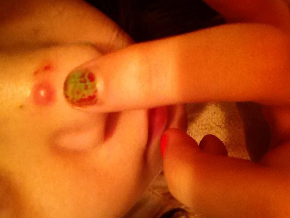 Hilfe Blase An Der Nase Was Ist Das Arzt Krank