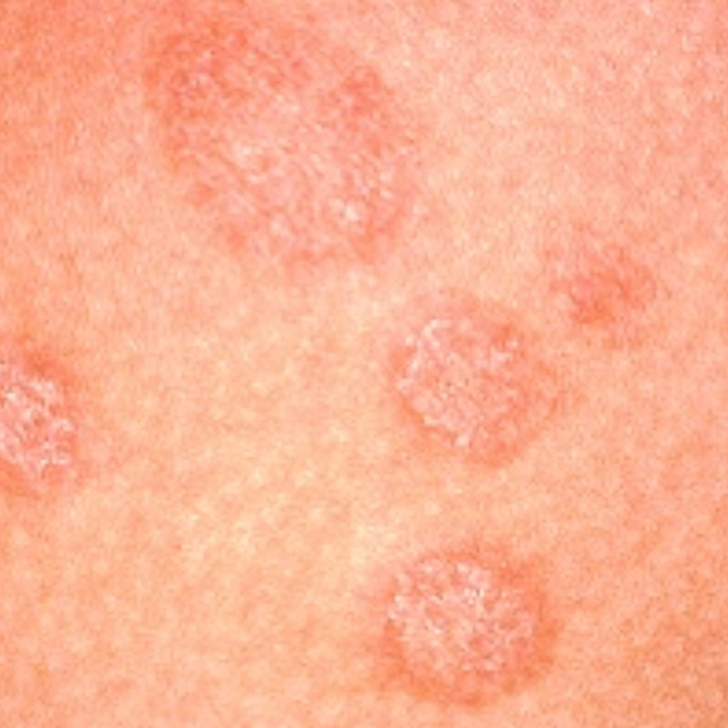 Braune Kreisrunde Flecken Haut 5 Jahre