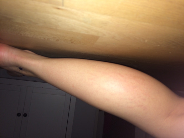 Hilfe Dehnungsstreifen An Wade Madchen Medizin Haut