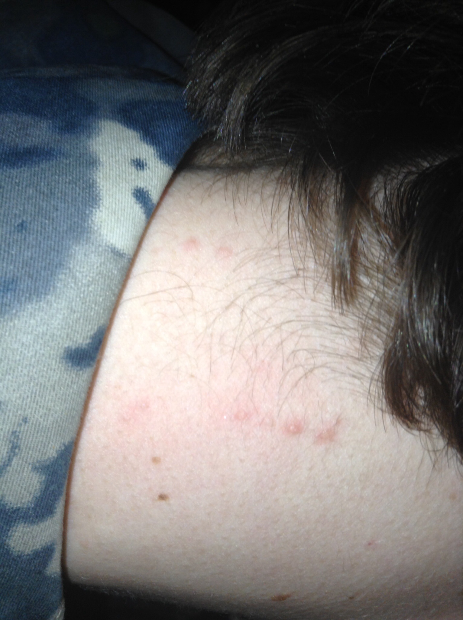 Habe Mehrere Juckende Punkte Auf Dem Nacken Ist Das Schlimm Korper Krankheit Habe Mehrere Juckende Punkte Auf Dem Nacken Ist Das Schlimm Korper Krankheit