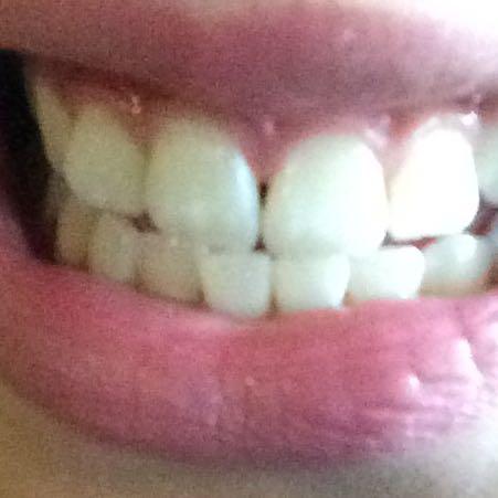 .. Ich weiß,mehr Zahnpflege... - (Gesundheit, Zähne, Zahnspange)
