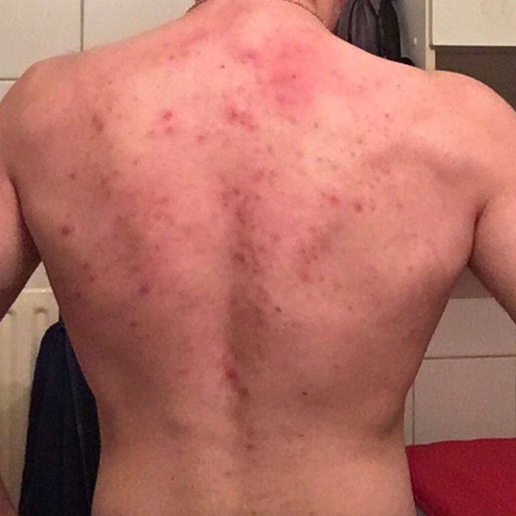 Hilfe Akne am Rücken was tun/-)/? (Gesundheit und Medizin ...