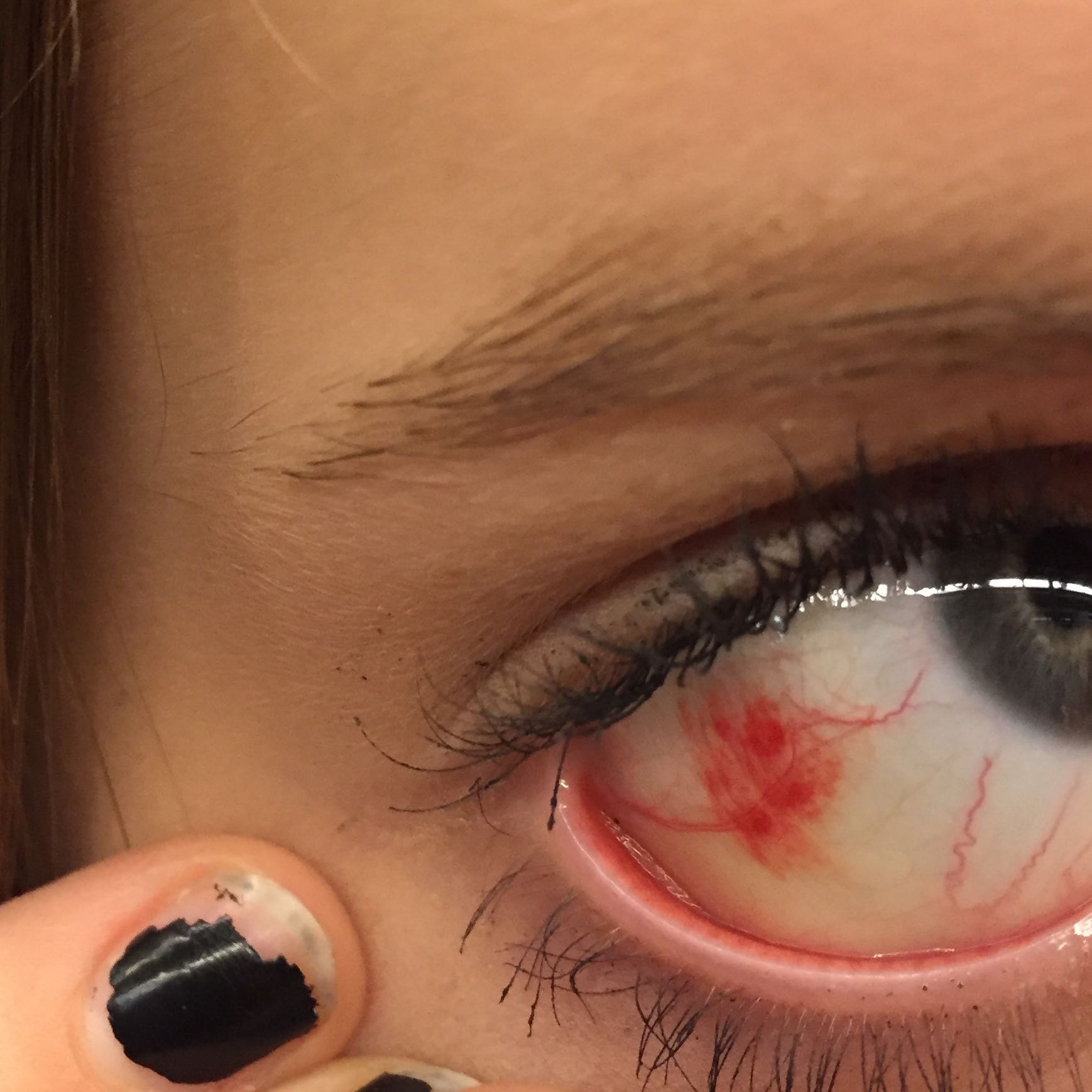 Hilfe auge ader geplatzt? (Arzt, Augen, Blut)