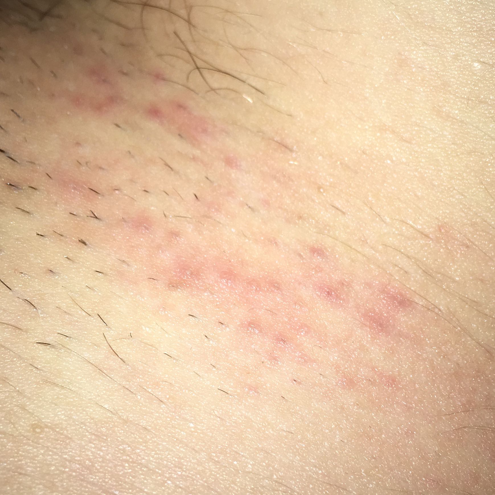 Hilfe Ausschlag im Intimbereich? (Krankheit, intim)