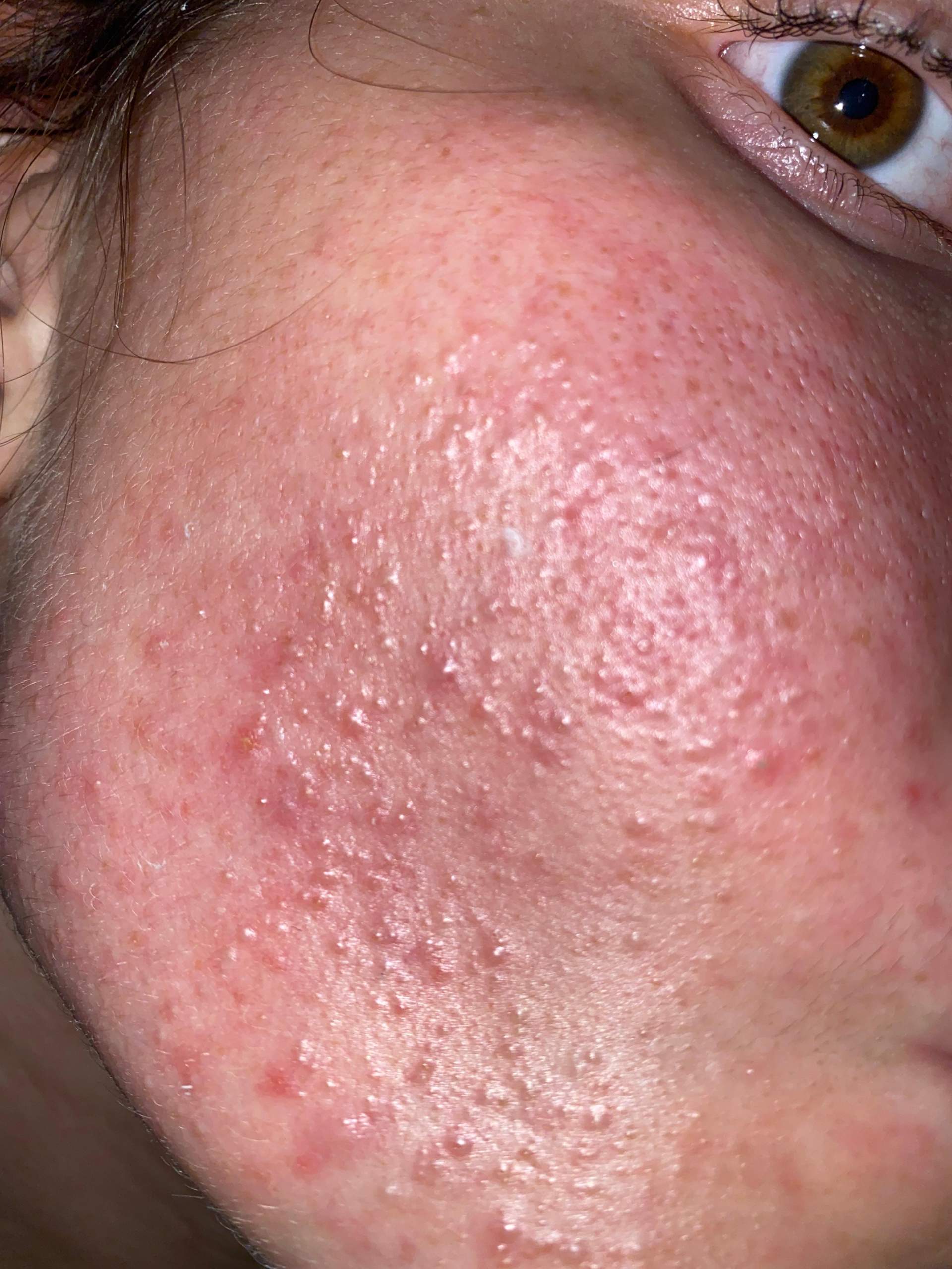 Hilfe bei Hautproblem (Akne/Milien)? (Gesundheit und Medizin, Haut, Pille)