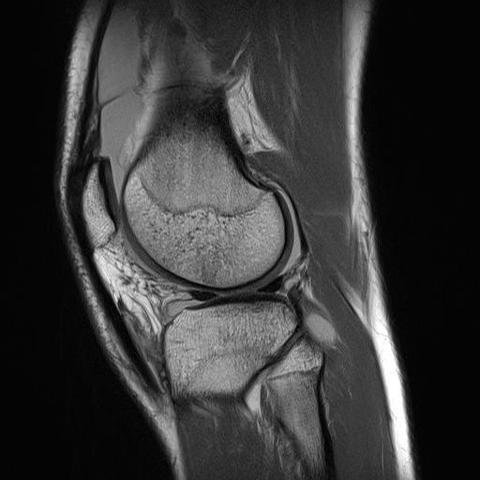 MRI Knie links - (Knie, MRT, Meniskus)