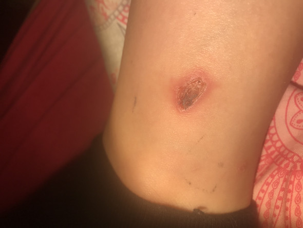 Hilfe Bei Wunde Gesucht Gesundheit Und Medizin Entzundet Kruste Hilfe Bei Wunde Gesucht Gesundheit Und Medizin Entzundet Kruste